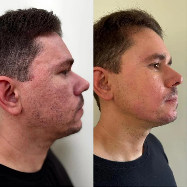 Cicatriz de acne 1