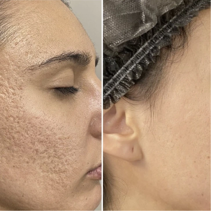 Cicatriz de acne 2