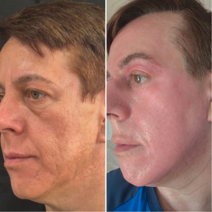 Cicatriz de acne 3
