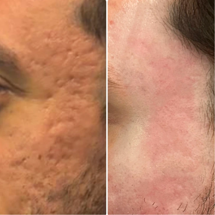Cicatriz de acne 4